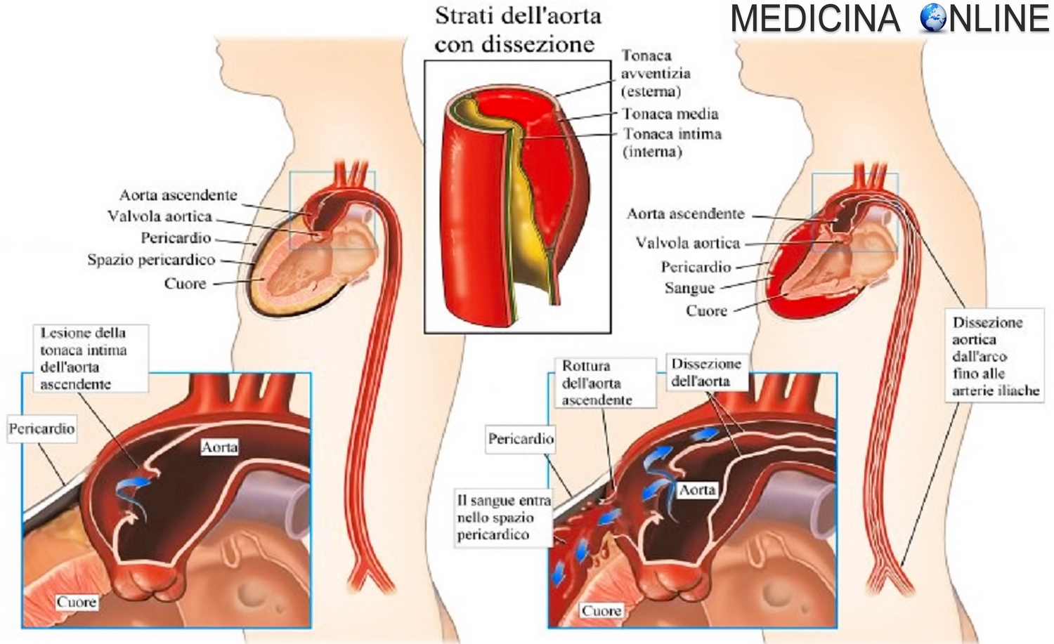 Aspettativa di vita dopo sostituzione valvola aortica